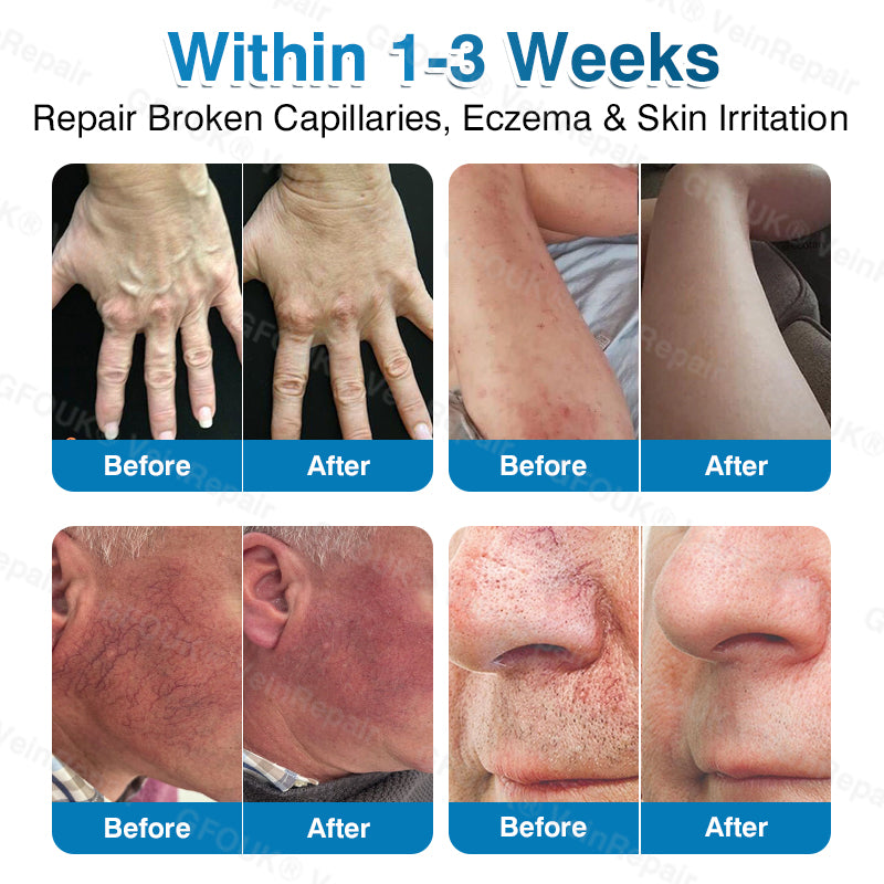 🇨🇦🏅🦵✨GFOUK® VeinRepair Microneedle Patch Roll⚡Instant Relief, Long-Term Results
