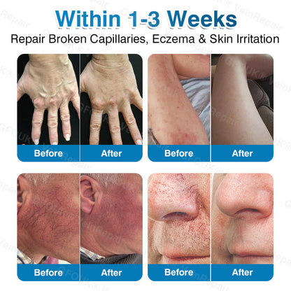 🇨🇦🏅🦵✨GFOUK® VeinRepair Microneedle Patch Roll⚡Instant Relief, Long-Term Results