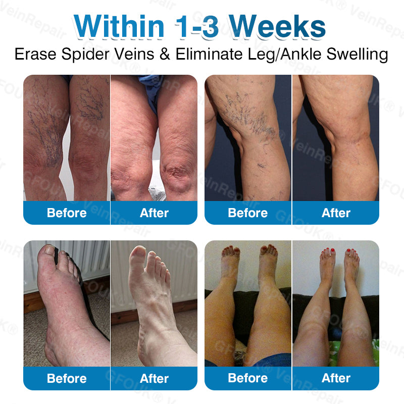 🇨🇦🏅🦵✨GFOUK® VeinRepair Microneedle Patch Roll⚡Instant Relief, Long-Term Results