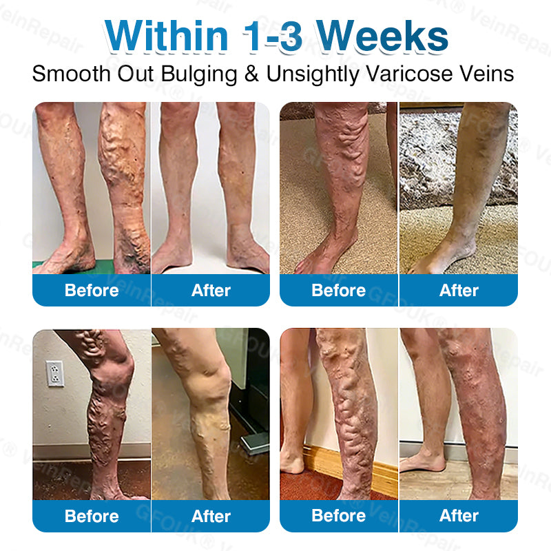 🇨🇦🏅🦵✨GFOUK® VeinRepair Microneedle Patch Roll⚡Instant Relief, Long-Term Results