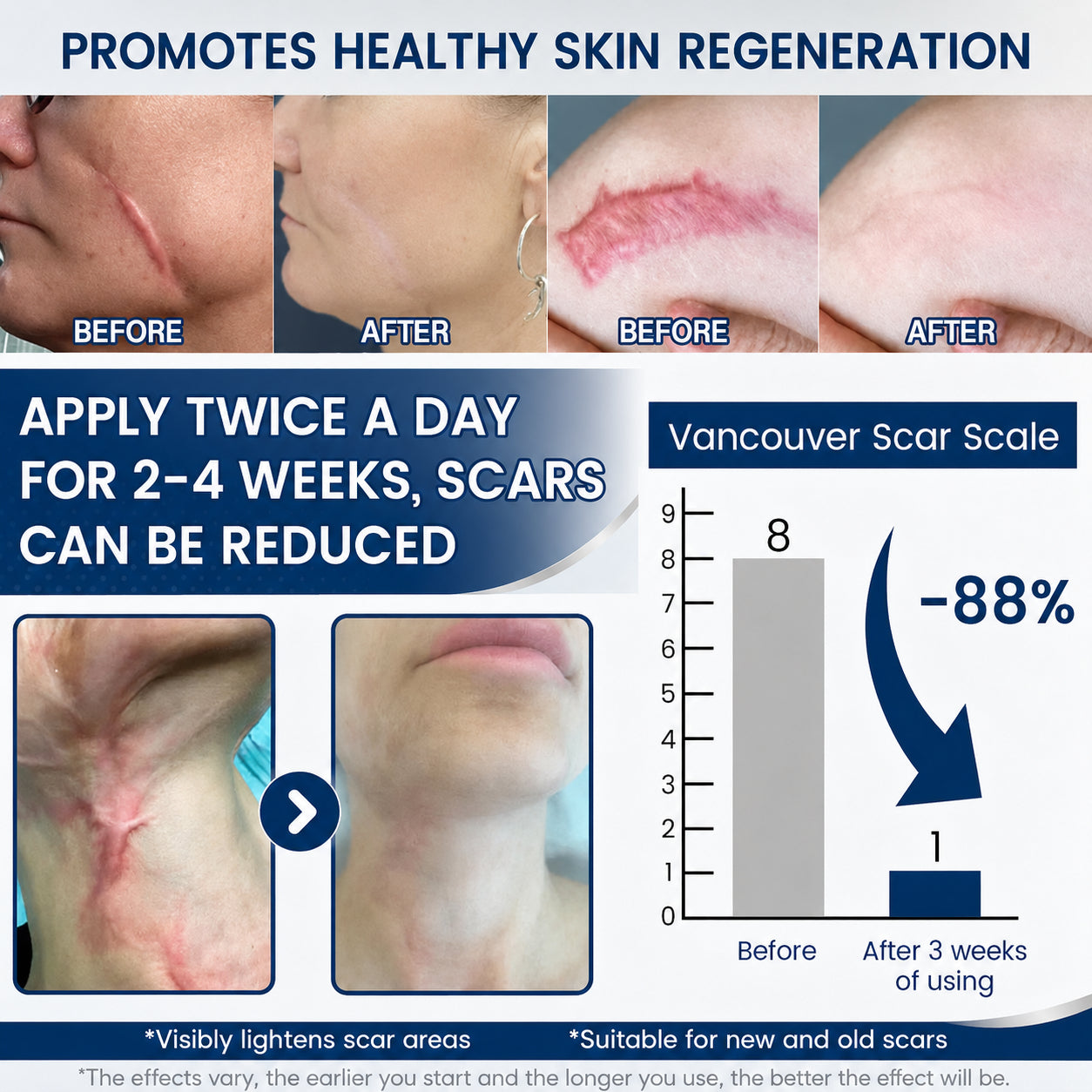 Hixvor™: Flatten, Fade, And Improve Your Scars In 14 Days